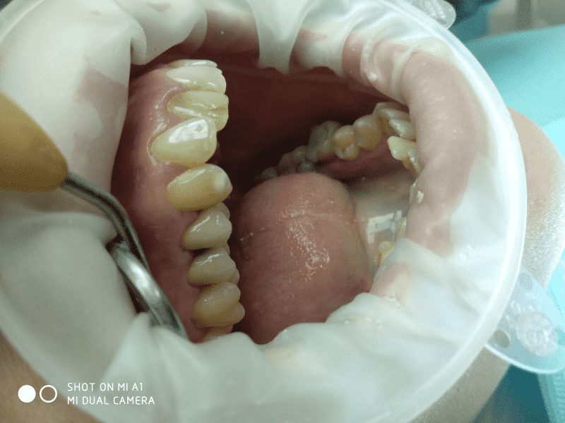 Пример лечения кариеса в стоматологии Белая Лилия в Малаховке
